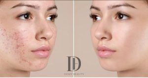 Điều trị mụn coog nghệ cao tại DoHy